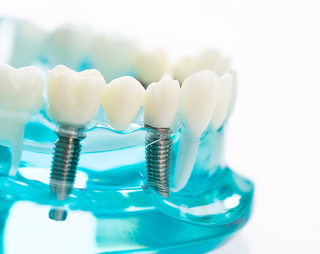 Best Dental Implant Treatment