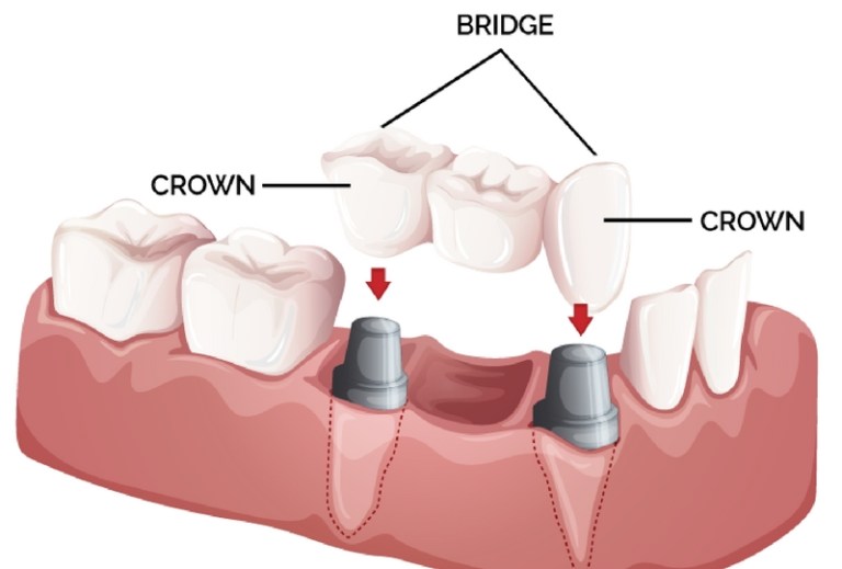 Teeth Bridge Treatment