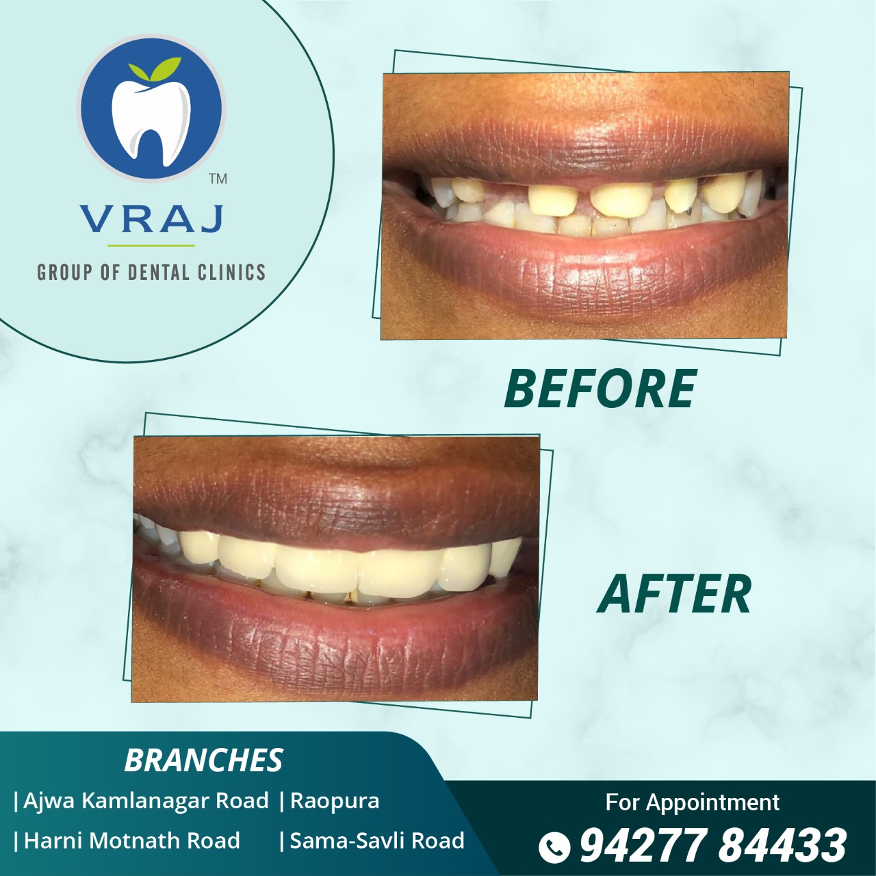 Smile Design Dentistry In Vadodara