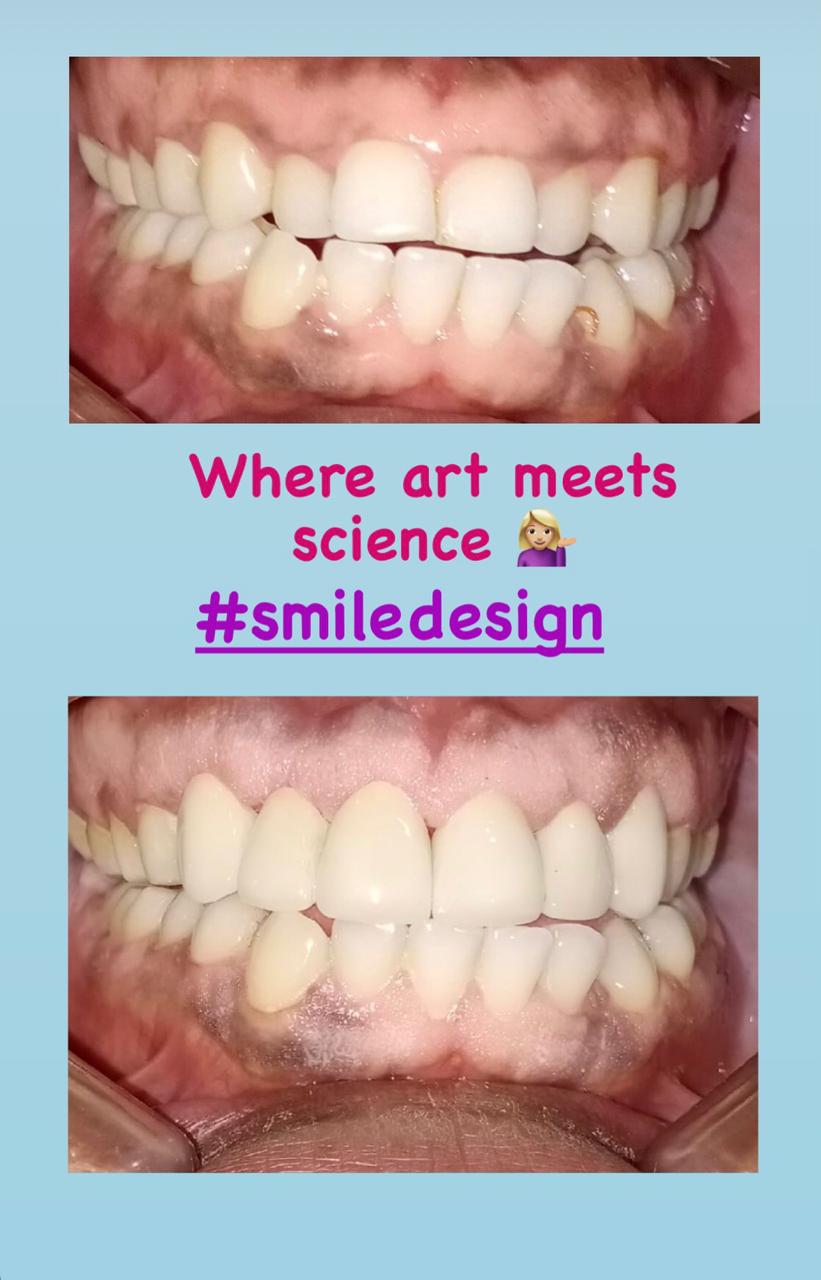 smile Design